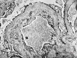 F,18y. | type I membranoproliferative glomerulonephritis F,18y. | type I membranoproliferative glomerulonephritis